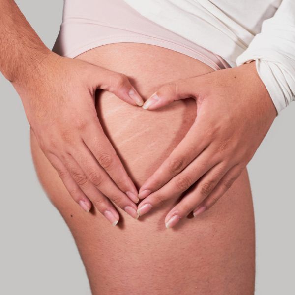 Indiba corporal Madrid-celulitis